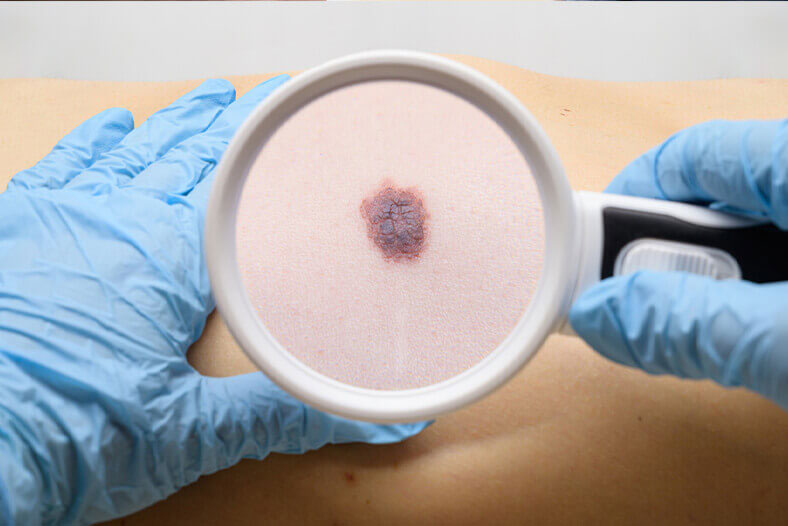 Cervical cancer سرطان دهانه رحم سینرژیک سید synergyseeds
